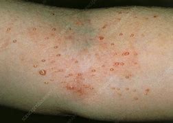 Image result for Molluscum or Warts