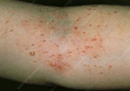 Image result for Trypophobia Skin Disease