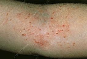 Image result for Molluscum Viral Skin Infection