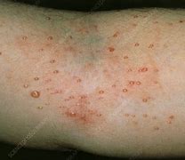 Image result for Molluscum Contagiosum Rash