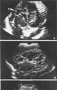 Image result for Anechoic Lacunar Ultrasound