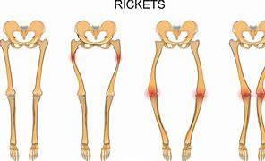 Image result for Rickets Vector