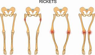 Image result for Rickets Animation