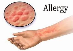 Image result for Stress Allergy Symptoms