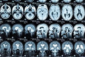 Image result for Hydrocephalus Brain Scan