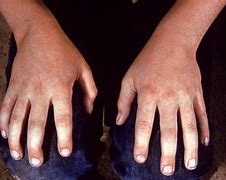 Image result for Fifths Disease Rash