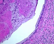 Image result for Nabothian Cyst Histology