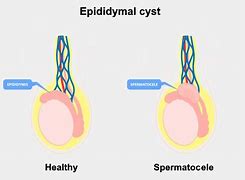 Image result for Epididymal Cyst Size Chart