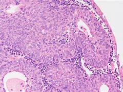 Image result for Inverted Papilloma Causes