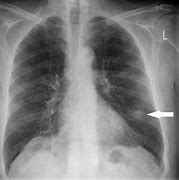 Image result for Solitary Pulmonary Nodule Biopsy
