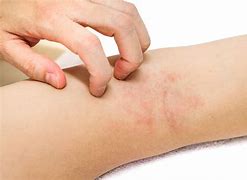 Image result for Eczema/Dermatitis