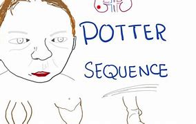 Image result for Potter's Sequence