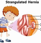 Image result for Small Intestine Hernia