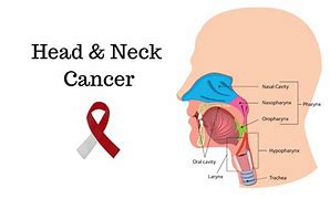 Image result for Tumor Biopsies in Head and Neck Cancer