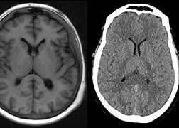 Image result for OCD Brain Scan