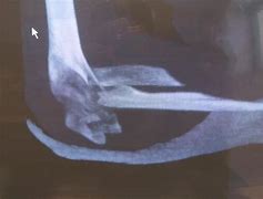 Image result for Closed Reduction Monteggia Fracture
