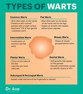 Image result for Different Types of Warts