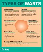 Image result for Types of Warts