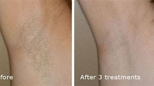Image result for Most Effective Laser Hair Removal