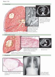 Image result for Benign Lung Tumor