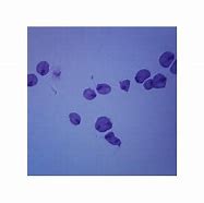 Image result for Trichomonas Pap Smear
