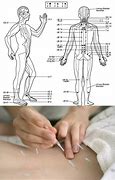 Image result for Acupuncture Pain Relief