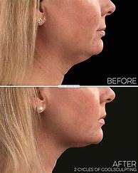 Image result for CoolSculpting On Double Chin