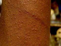 Image result for Allergy Rash On Black Person