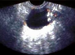 Image result for Transvaginal Ultrasound Ovarian Cyst