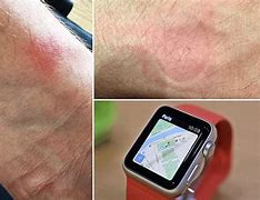 Image result for Apple Watch Burning Wrist