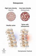 Image result for Osteoporosis Lumbar Spine