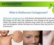 Image result for molluscum contagiosum home remedy