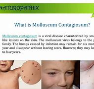 Image result for Molluscum Contagiosum Causes