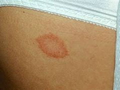 Image result for Pityriasis Rosea