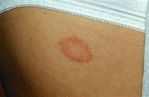 Image result for Circular Lesions On Skin