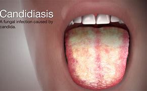 Image result for Candidiasis Ano