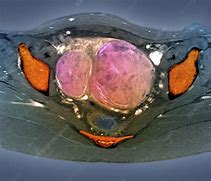 Image result for Uterine Fibroid Tumors