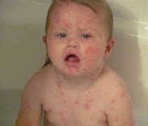 Image result for Chicken Pox