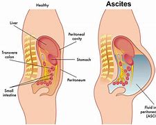 Image result for ascitis