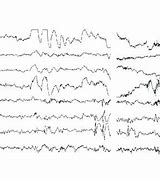 Image result for EEG Occipital Spikes