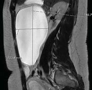 Image result for Right Adnexal Cyst