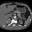 Image result for Renal Cyst Radiology