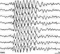 Image result for Bilateral Sharp Spikes EEG