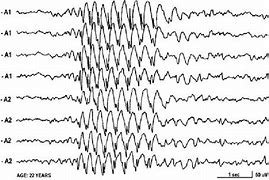 Image result for Multifocal Spikes EEG
