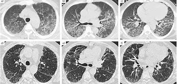 Image result for Granuloma Lung Nodule