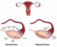 Image result for 6 Cm Ovarian Cyst
