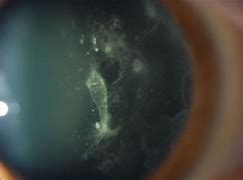 Image result for Slit Lamp Retina