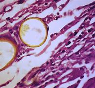 Image result for Sinus Infection Rotten Smell Eggs