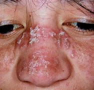 Image result for Lupus Rash around Mouth