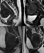 Image result for Fundal Uterine Fibroid